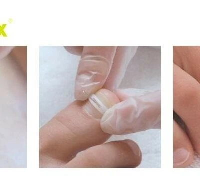 Podofix nagelbeugel complete set